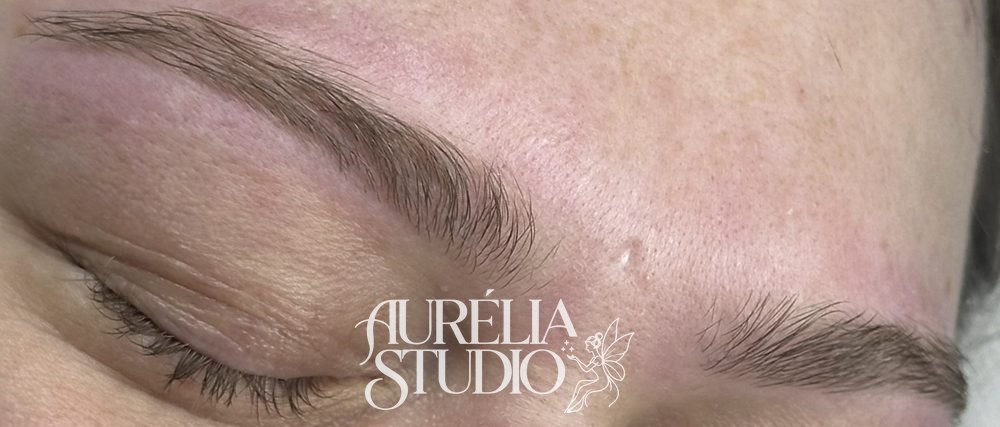 Brow lift